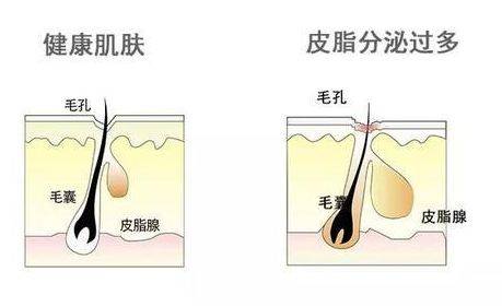 祛痘|谨慎跟风盲入小红书的推荐！孕期护肤品按肤质选，做不到活该烂脸