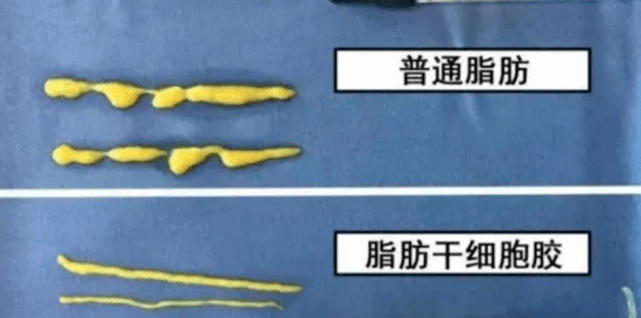 脸部|脂肪胶填充脸部可以维持多久？面部脂肪胶填充能管多久？想知道的看看