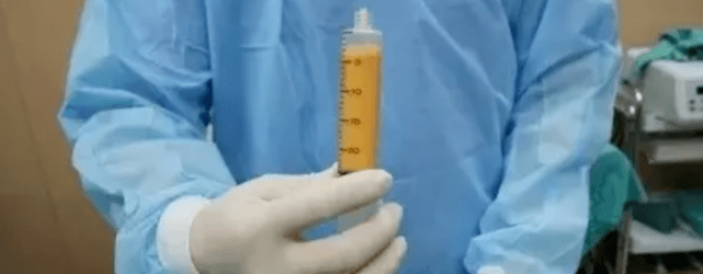 脸部|脂肪胶填充脸部可以维持多久？面部脂肪胶填充能管多久？想知道的看看