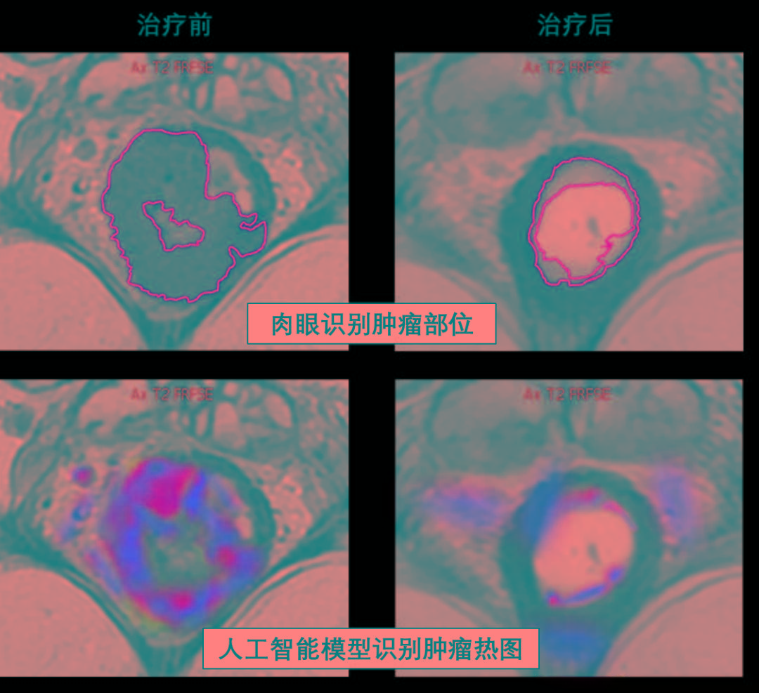 滑膜肉瘤 个体化ny Eso 1癌睾抗原肽纳米疫苗为基础的综合免疫治疗达完全缓解 与癌争锋