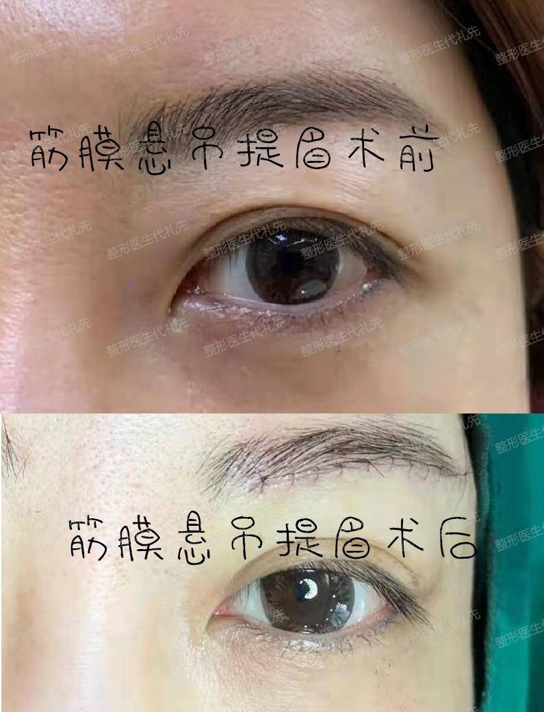 进行总结提眉手术大家问得最多的20个问题，一起来看看