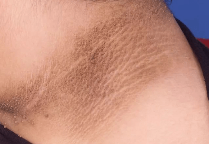 血液|红花双酸里有什么?怎么降血糖?