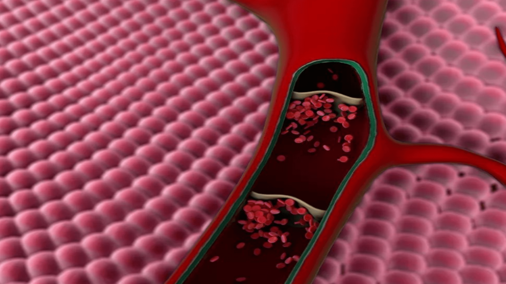 建议|长期口服避孕药，25岁少女被这病盯上，患上“肺梗”