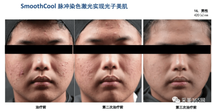 脂肪采美机构开业推荐:韩国Jeisys再希思SmoothCool冰柔极光-高性价比的光子嫩肤仪