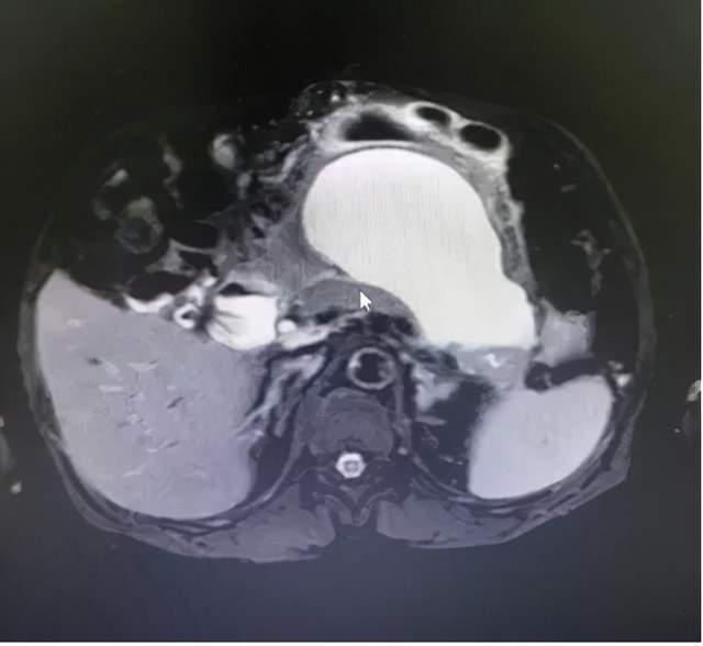 吕梁|新技术！山西省汾阳医院消化内科又一项联合技术填补吕梁空白
