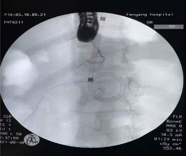 吕梁|新技术！山西省汾阳医院消化内科又一项联合技术填补吕梁空白