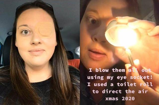 英女患罕见病痛失左眼,她苦中作乐竟练就"眼洞吹蜡烛"绝技