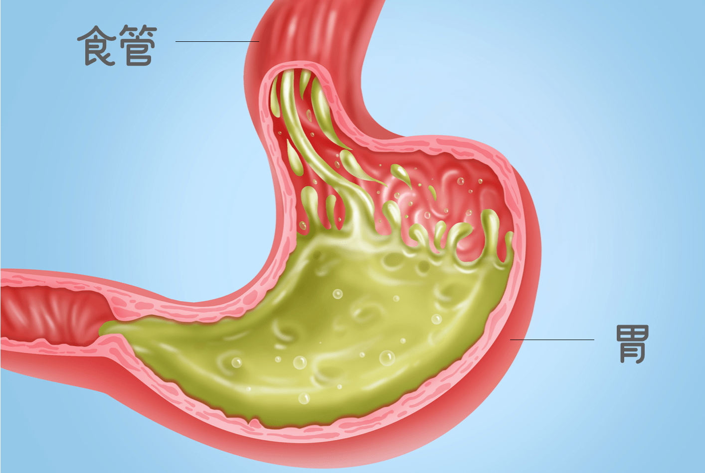 什么|反酸又烧心?这可不是什么小毛病!千万别大意