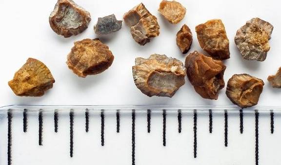 治疗|肾脏被“结石”占领，可能会有2个危害，别忍忍就算了