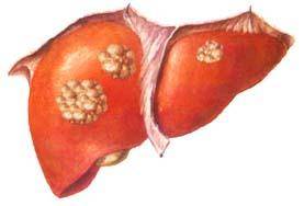 知识科普|肝有癌,身体知!若身体出现6个“异常”,及时检查