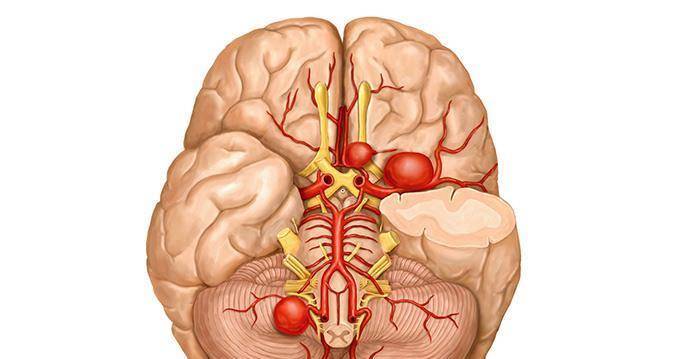 变化|患上脑血管瘤后，尽管平常只是洗了个澡，结果却悲剧了