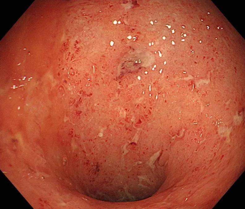 航天城|危言耸听？溃疡性结肠炎活不过10年！