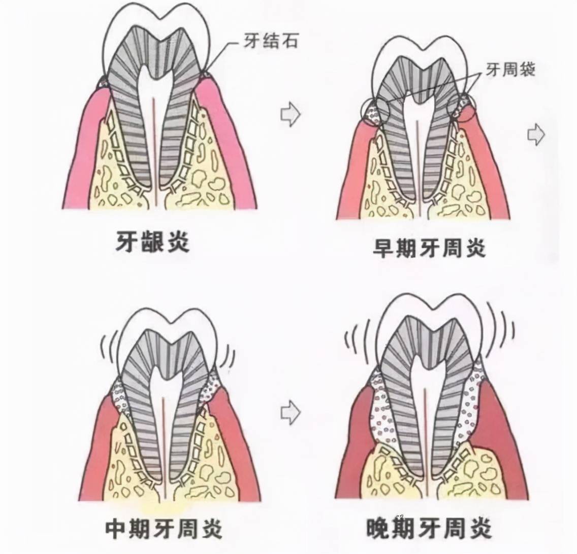 牙刺怎么去掉图片