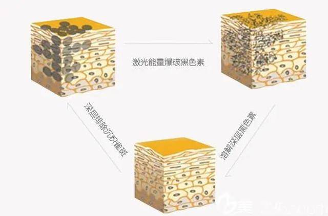 内调郑州美莱—科学祛斑的内调外养，具体要怎么操作呢？