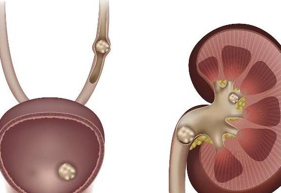 尿酸|肾结石是怎么形成的？劝告：这5类食物，别再贪嘴多吃