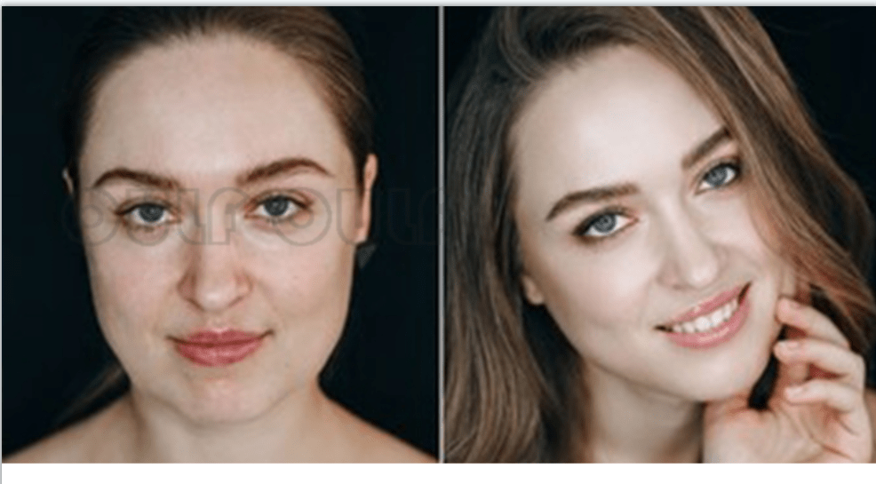 存活率做完脂肪填充后遗症 下垂咋回事~