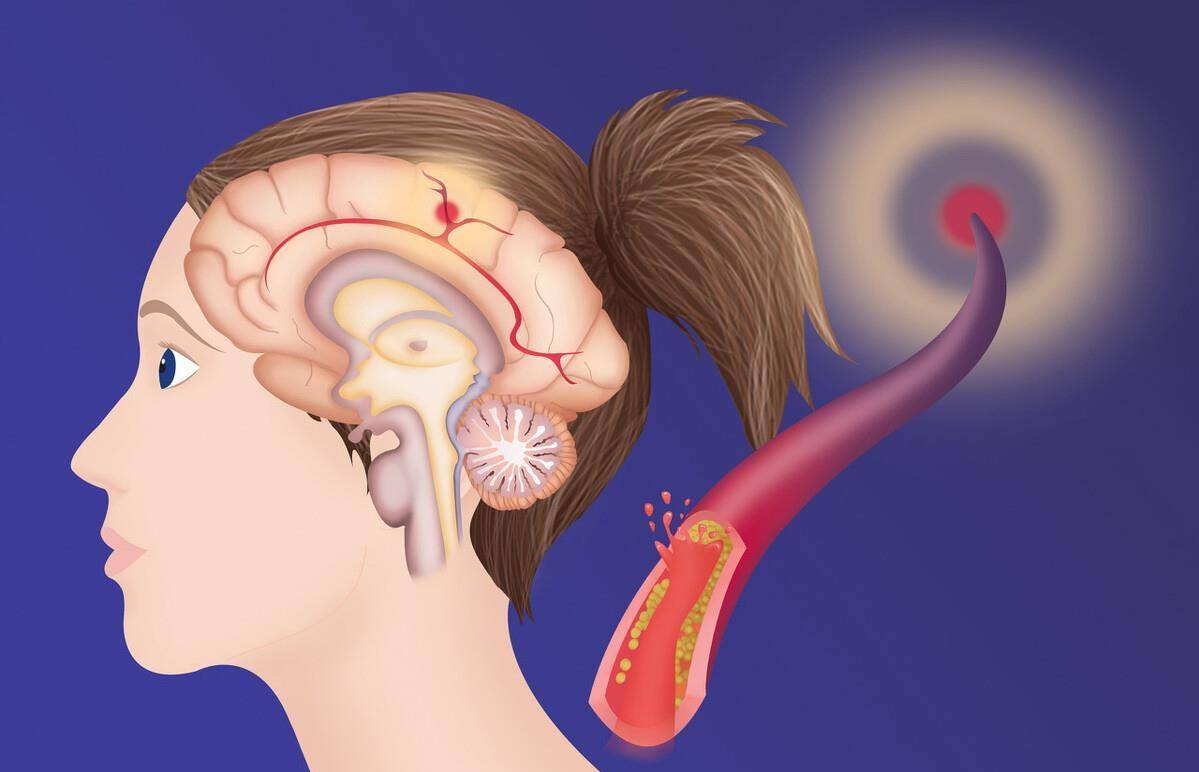 症状|餐后血糖升高，会出现哪些症状？医生说：有人会有这种感受