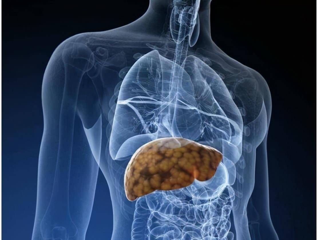 脾脏|70岁老太太吐血1.3升，胃镜检查却发现和肝有关，严重时危及生命