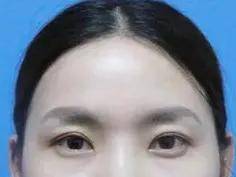 手术|如何do鼻子才能有好的效果？