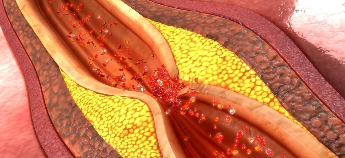 他汀|他汀类药物，什么人需要吃，血脂恢复到正常后可以停药么？