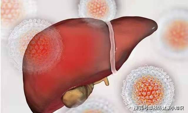 治疗|乙肝携带者有可能发展成肝癌吗?遵循以下原则,或有希望治愈