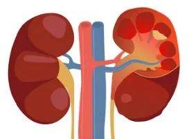 防护|【健康知识科普】秋季肾病容易复发？日常生活中如何做好防护？