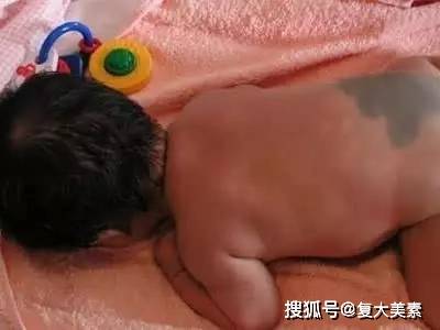 眼睛复大美素：要祛斑，这些色斑面诊原理你要懂！