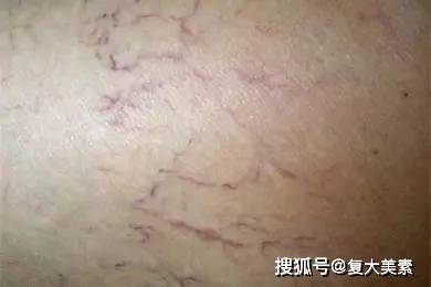 眼睛复大美素：要祛斑，这些色斑面诊原理你要懂！