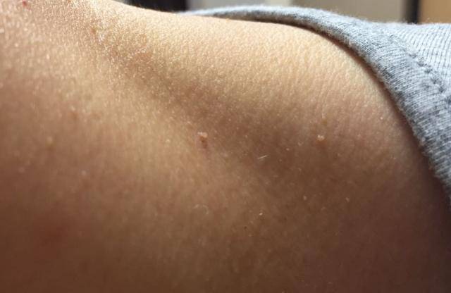 身上长"瘊子"或许就是hpv携带者,医生:无论男女,都需警惕