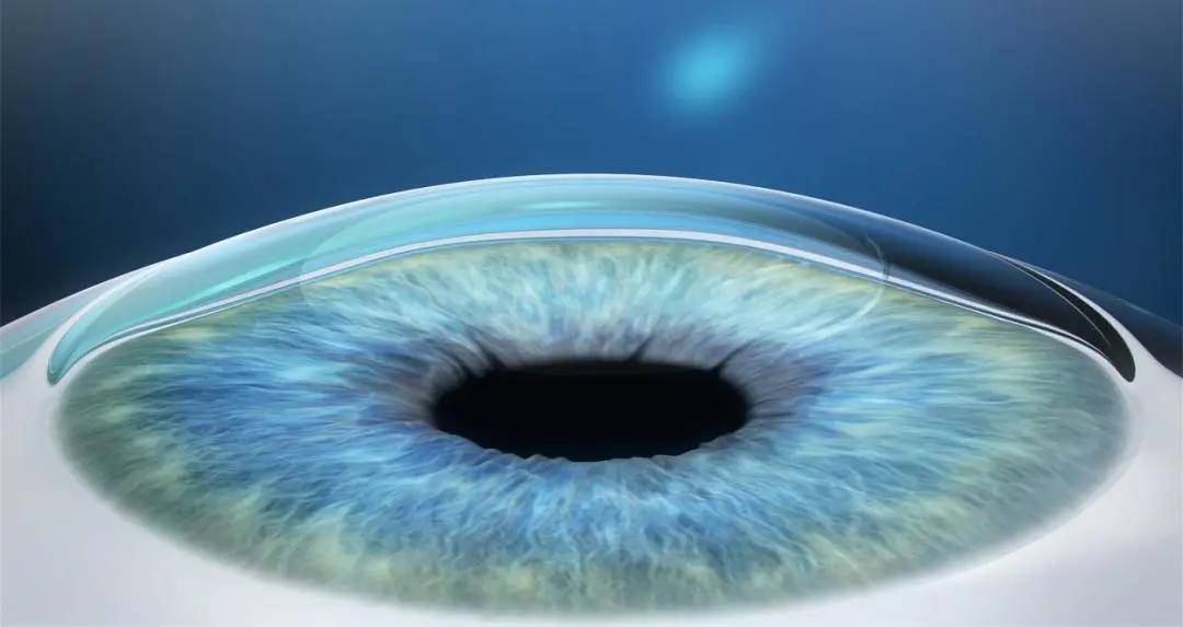 激光近视手术原理图解 64af140f15ef4553aa9f56583537fdd1.jpeg