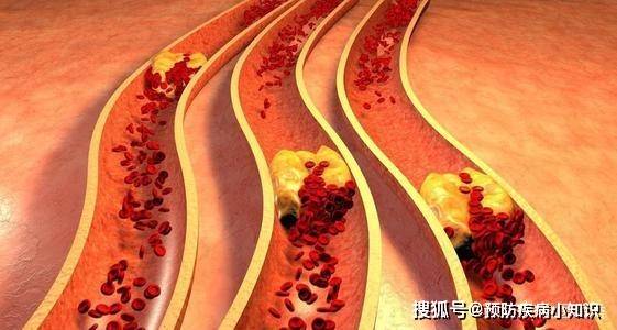 饮食|为什么在中国，脑梗患者越来越多？医生：与肥肉无关，望你了解