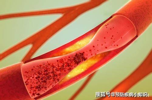 饮食|为什么在中国，脑梗患者越来越多？医生：与肥肉无关，望你了解