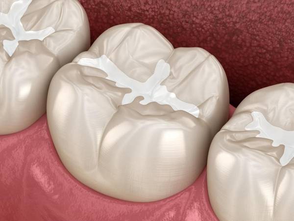 植得|儿童青少年龋病高发 植得口腔加强龋齿防治工作