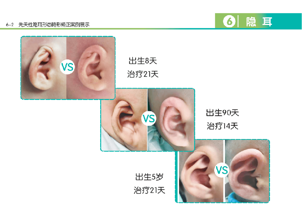 新生兒先天性耳廓畸形的篩查及治療流程