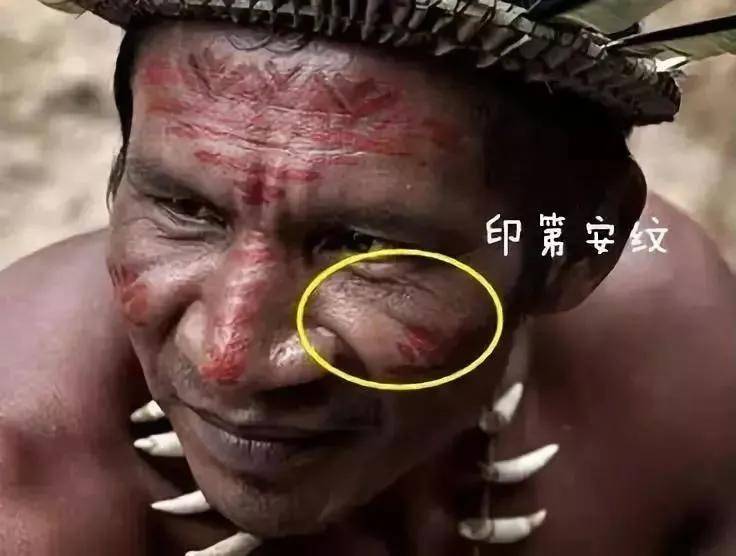颧骨拉垮颜值的“印第安纹”，终于找上了95后
