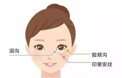 颧骨拉垮颜值的“印第安纹”，终于找上了95后