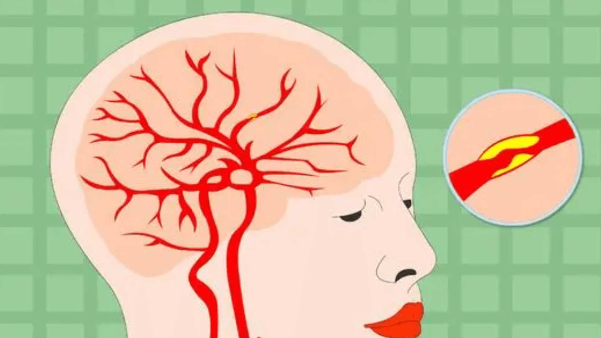 有关|为什么女子脑血管堵了？和吃避孕药有关，长期服用避孕药的危害