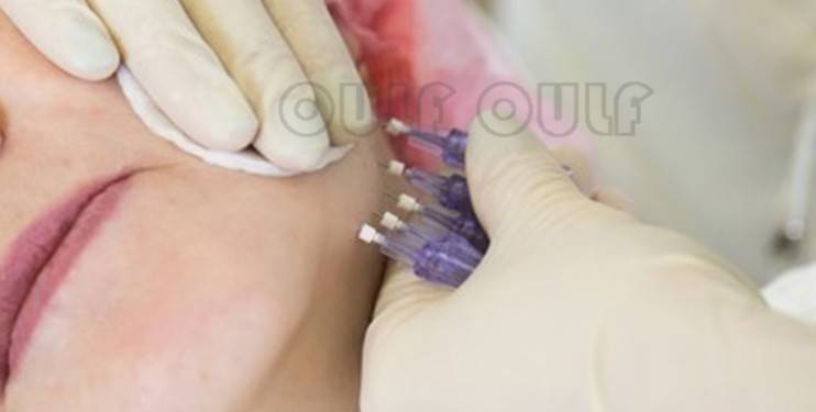 蛋白线雕面部出现凹陷可以补救吗？面部线雕做过的来说说！