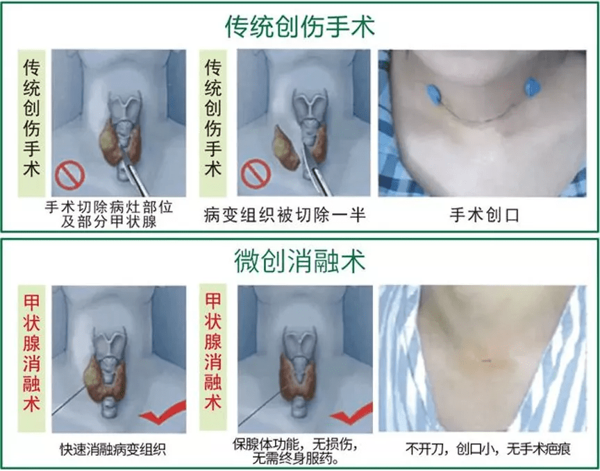 生活|省内领先！不开刀、“扎一针”就能治好甲状腺结节