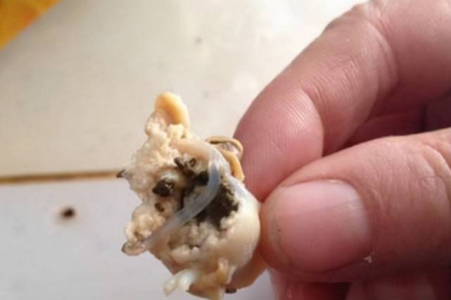 肝脏|肝癌多是“吃”出来的？医生：身体若有4种异常，肝脏或已“千疮百孔”