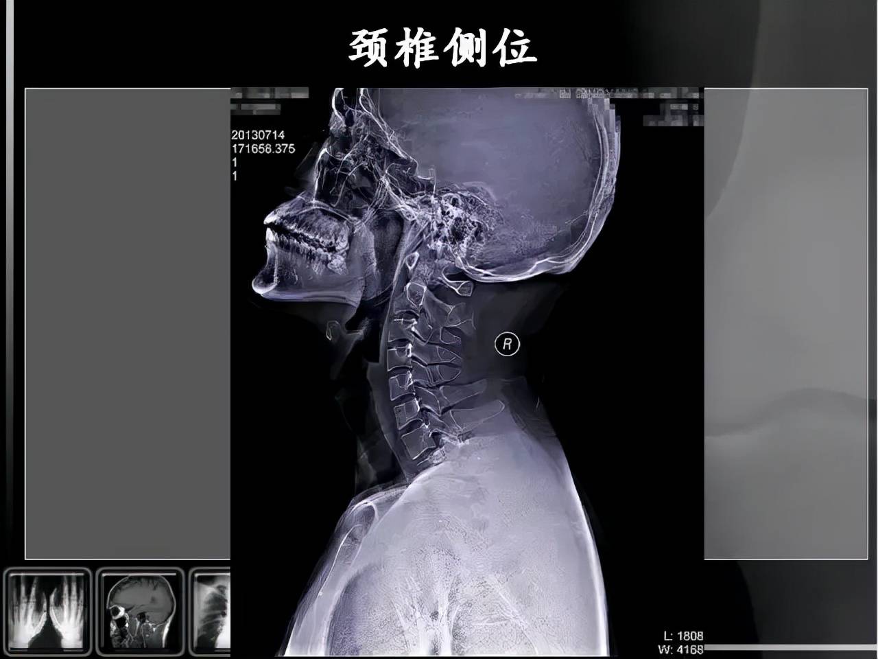 颈椎病的x线检查