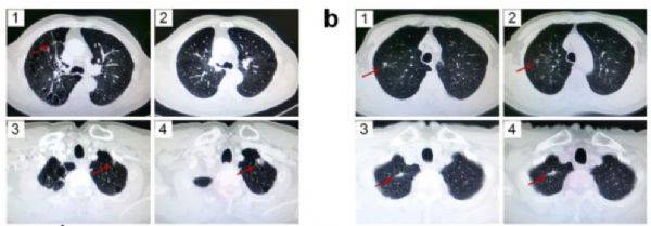 细胞|综述：nk细胞相关最新研究进展/成果（2021年）