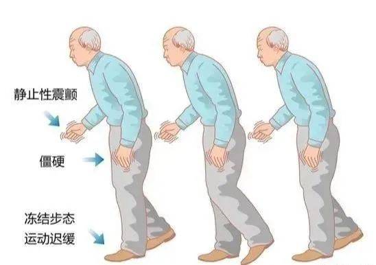 及病人症状的不同选用帕金森病体操,太极,关节活动范围训练,步态训练