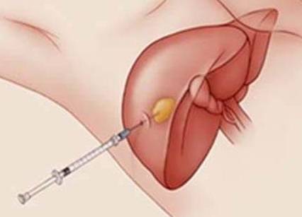 肝脏|从肝病的角度看，右上腹疼痛一般是什么原因？应该如何应对？