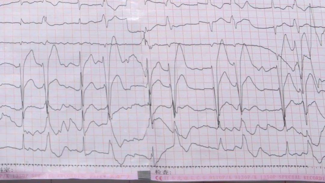 草乌|腹泻、胸闷、浑身无力...煮食附子中毒入院，医生建议：食用这些药材需谨慎！