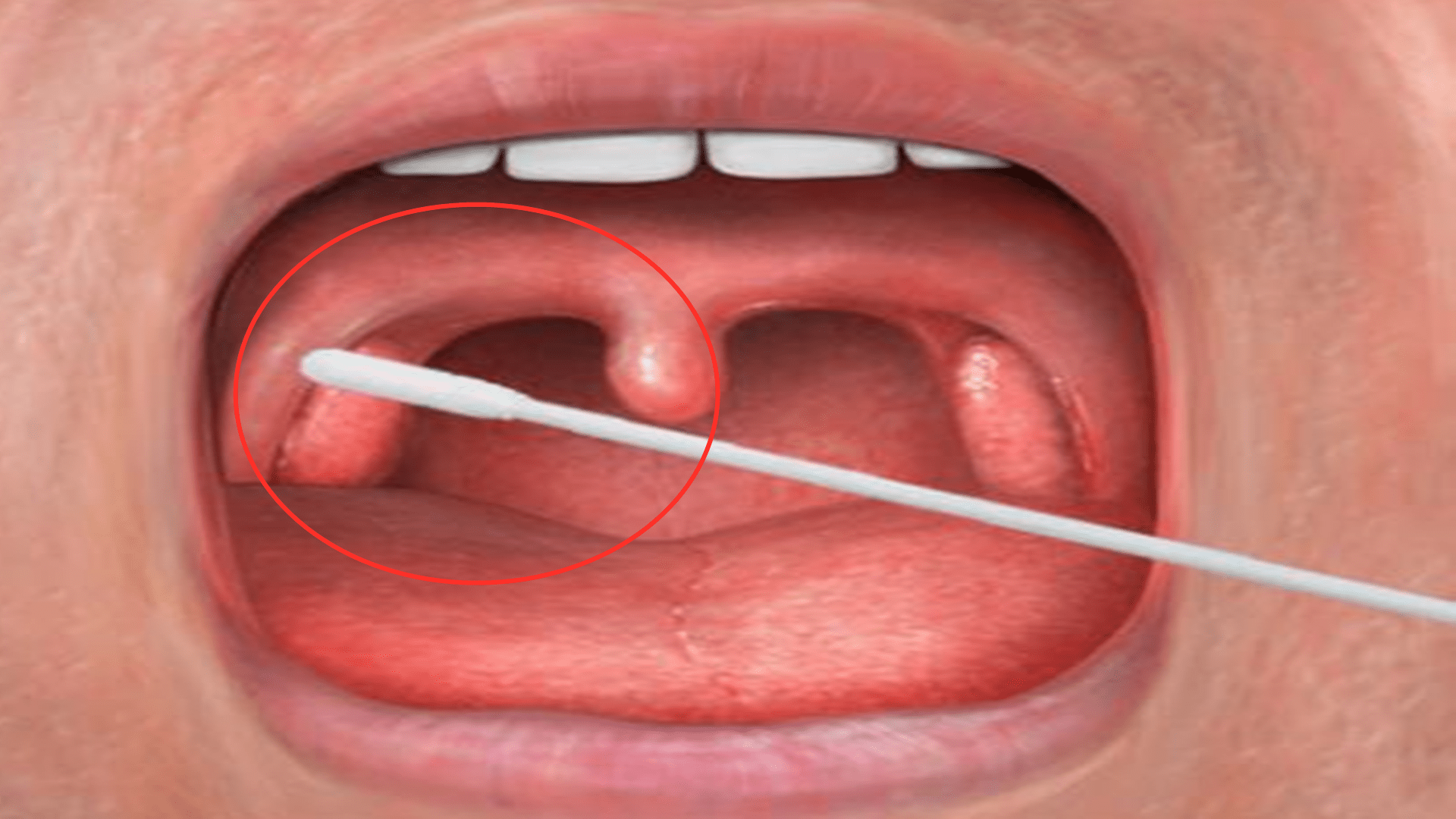 疑问|口鼻咽拭子哪个更准？一般情况下，鼻咽拭子检出率更高
