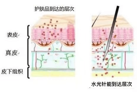 知识科普打水光针的注意事项及技巧！这5点记下效果更好！