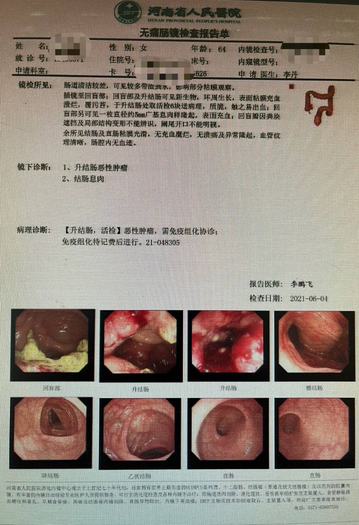 肠癌晚期照片图片