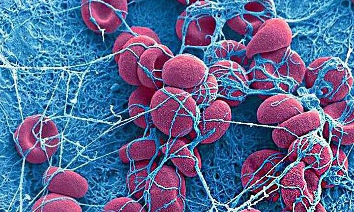 症状|乙肝十几年，肝功转氨酶和胆红素高，早晨咳嗽有血痰，是肝硬化吗