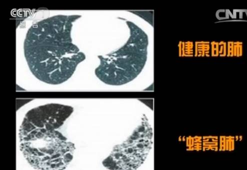 活动|肺纤维化是怎么回事?咳嗽、气短,这三类人是高危人群